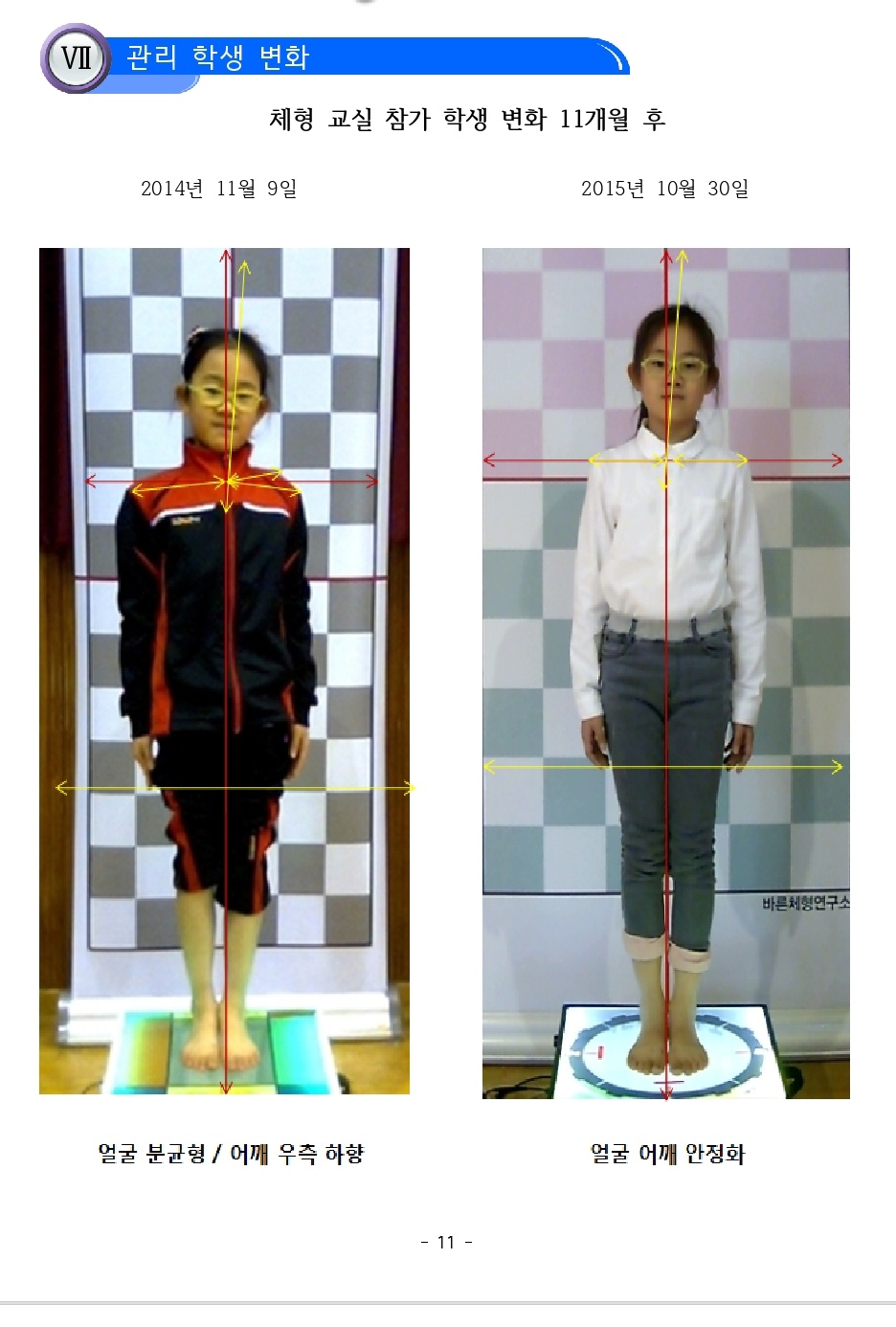 어깨 균형 개선 사례